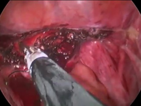 V-Lock Endostich
