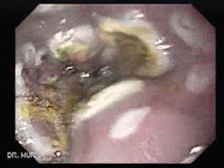 Endoscopic Ablation Of Barrett's Esophagus - 6/6