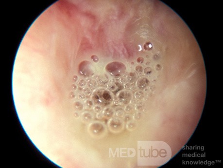 Discharge from Ventilation Tube