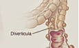 Sigmoid Resection vs Conservative Treatment After Diverticulitis Prespecified 4-Year Analysis of the LASER Randomized Clinic