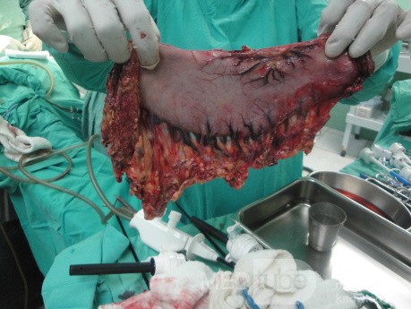Gastric Ulcerated Adenocarcinoma of the Pre-pyloric Antrum (18 of 28)