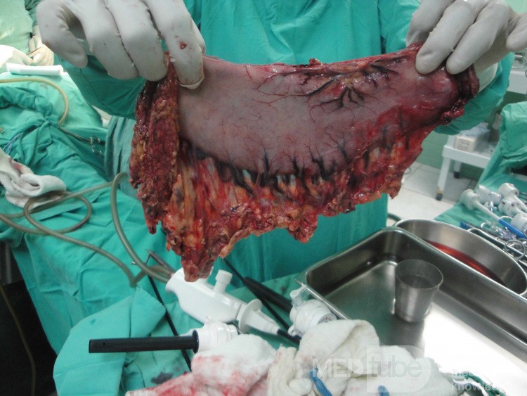 Gastric Ulcerated Adenocarcinoma of the Pre-pyloric Antrum (18 of 28)