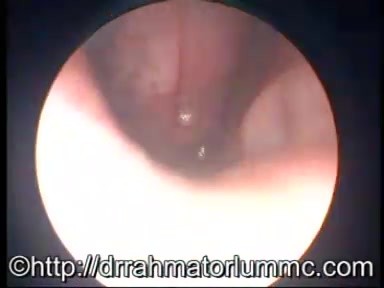 Nasopharyngeal Lymphoid Tissue Infection