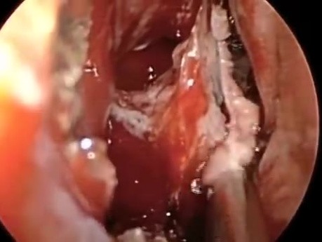 Transnasal Transsphenoideal Approach to the Pituitary