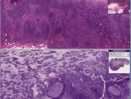Acute Lymphadenitis