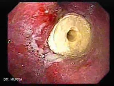 Gastric Cicatrization With Pylorus Stenosis (1 of 23)