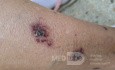 Vasculite? [2/6]
