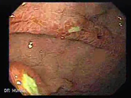 Duodenal Ulcers (3 of 4)