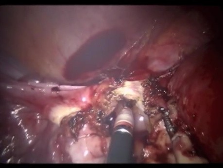Robotic Single-Site Hysterectomy