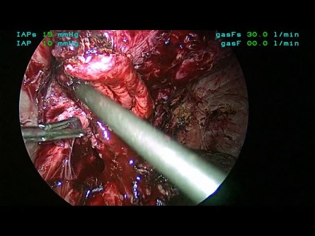 Laparoscopic Removal Of Eroded Mesh And Revision Of The Gastrojejunostomy