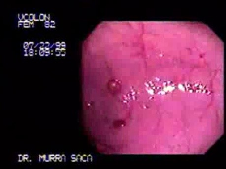 Splenic Flexure Colon Adenocarcinoma