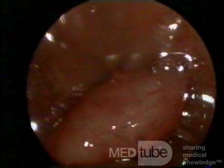 Hysteroscopy, polyp