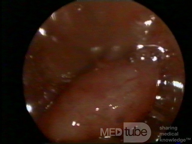 Hysteroscopy, polyp