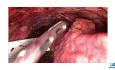 Laparoscopic Implantation of an Artificial Urinary Sphincter in a Pediatric Female