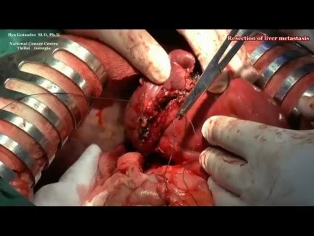 Cytoreductive Surgery for Advanced Colon Cancer