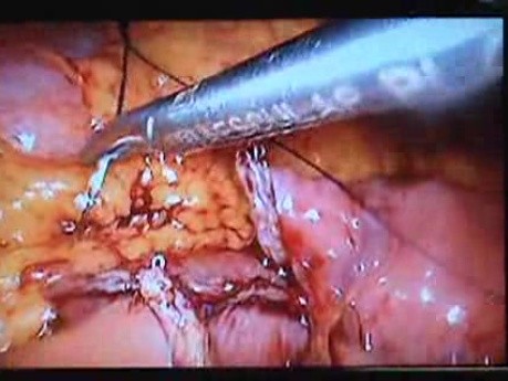 Jejunal Gastrointestinal Stromal tumor (GIST) (32 of 86)