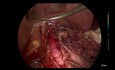 Laparoscopic Hellers Cardiomyotomy + DOR Fundoplication