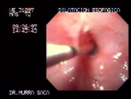 Esophageal Stricture Due To Ingestion Of Corrosive Substance - Endoscopy