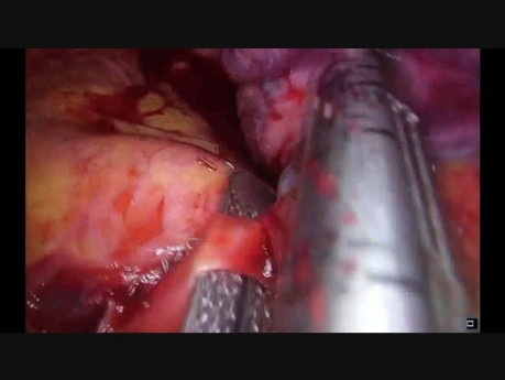 Uniportal VATS Lobectomy and Chest Wall Resection after Chemotherapy