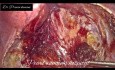 Laproscopic Peritoneal Vaginoplasty