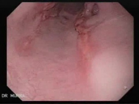 Reflux Esophagitis With Pseudo Diverticulum - Esophagoscopy - 2/2
