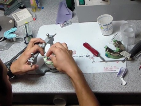 Soft Tissue Moulage Back Onto Cast Part 2