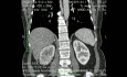 Inferior Vena Cava Tromboembolectomy with Radica Nephrectomy