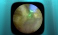 Ureteral Stone Treatment with Ureteroscopy and Pulsed Thulium Laser