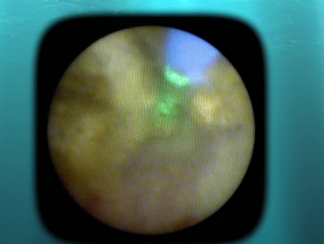 Ureteral Stone Treatment with Ureteroscopy and Pulsed Thulium Laser