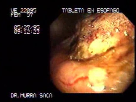 Ulcerated Gastric Carcinoma (2 of 2)