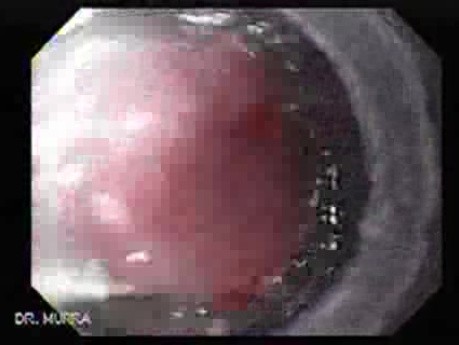 Alcoholic Cirrhosis - Banding of the Varix, Part 2