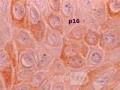 Histoplasmosis of the Colon and Condyloma Accuminata (7 of 11)