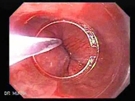 Mucosectomy as a Treatment for Early Gastric Cancer - End of the Procedure