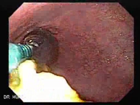 Esophageal Stricture After Total Gastrectomy And Chemoradiation - Baloon Dilation - 4/6