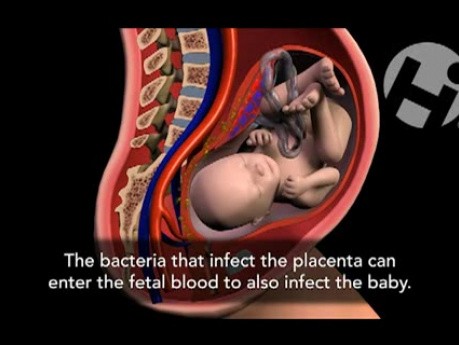 Chorioamnionitis
