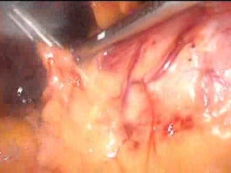 Gastrointestinal Stromal Tumor - GIST (21 of 65)