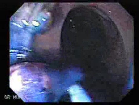 Juvenile Non Familial Polyposis of the Colon (29 of 37)