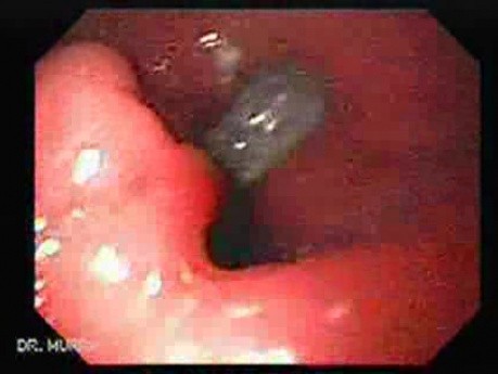 Two Ulcers in a Cirrhotic Patient - 82 Years-Old Woman