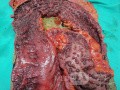 Multiple Rectal Ulcers (94 of 110)