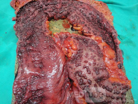 Multiple Rectal Ulcers (94 of 110)