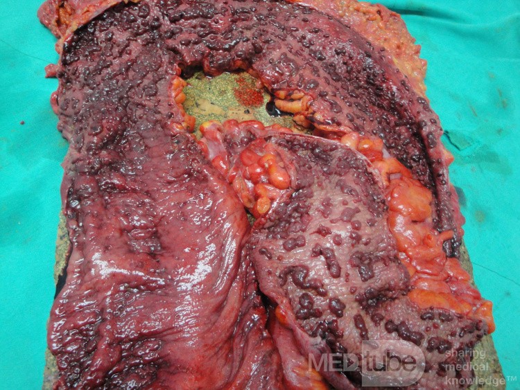 Multiple Rectal Ulcers (94 of 110)