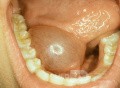 Ranula Floor of the Mouth [right]