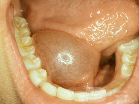 Ranula Floor of the Mouth [right]