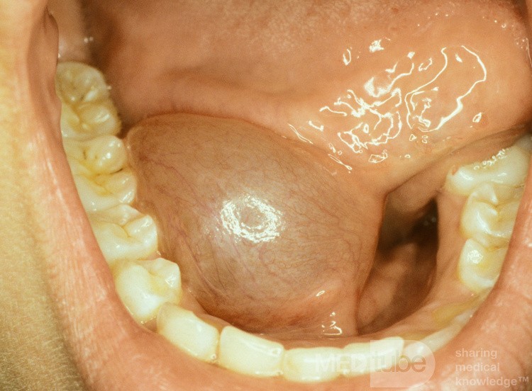 Ranula Floor of the Mouth [right]