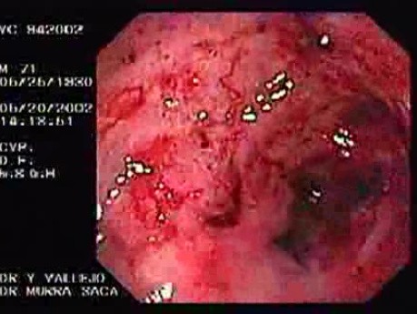 Radiation Proctosigmoiditis (3 of 14)
