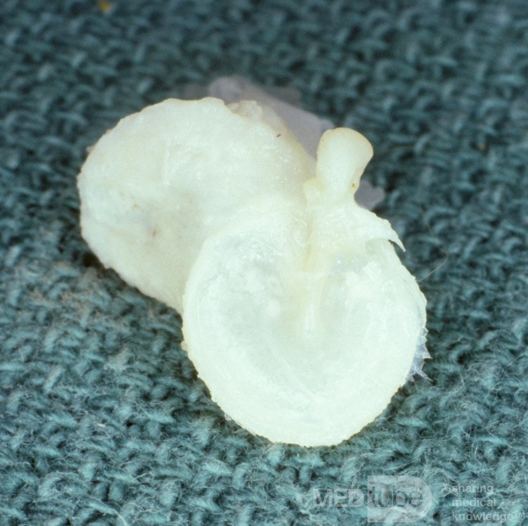 Tympanic Portion of the External Auditory Canal [Cadaveric Specimen]