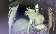 LV Restoration Surgery in Poor LV