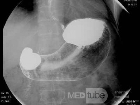 ScirrhousGastric Carcinoma (Linitis Plastica) (14 of 15)