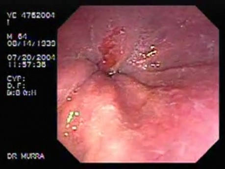 Barrett's Esophagus 
