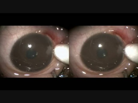 Pediatric Limbal Naevus